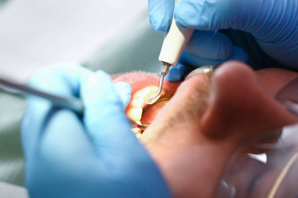 Best Knocked-Out Tooth (Avulsed Tooth) Treatment in Hopkins, MN
